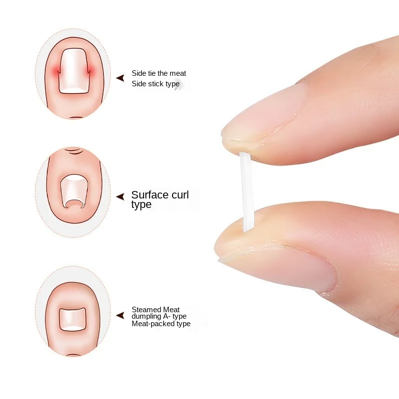 Toenail Filling Preventing Nail Inlays Treating Paronychia Pus Nails Correction of Nails Preventing Nails From Curling Inwards