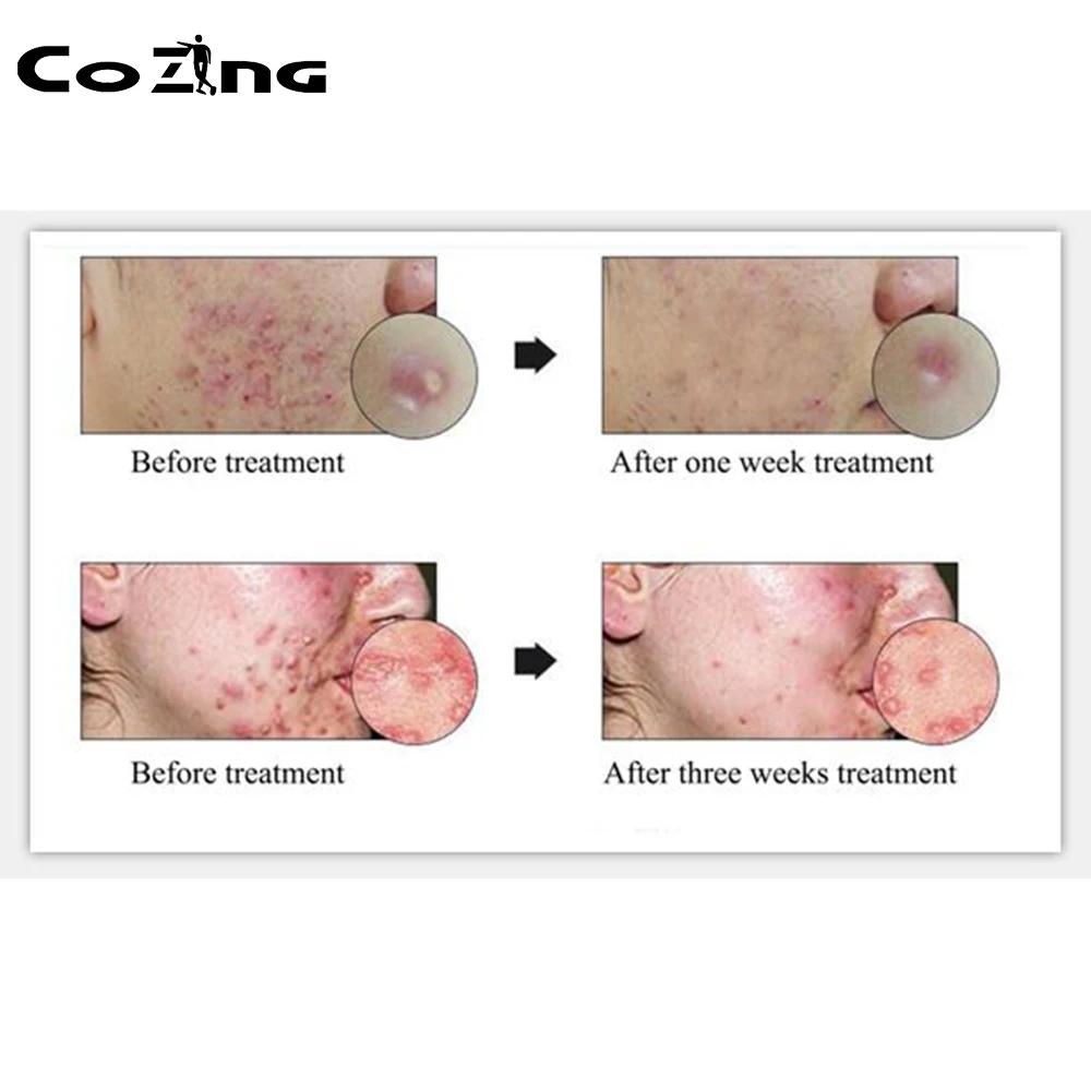 

Facial Rejuvenation Therapy Skin PDT Anti-aging Beauty Machine 2 Color LED Light