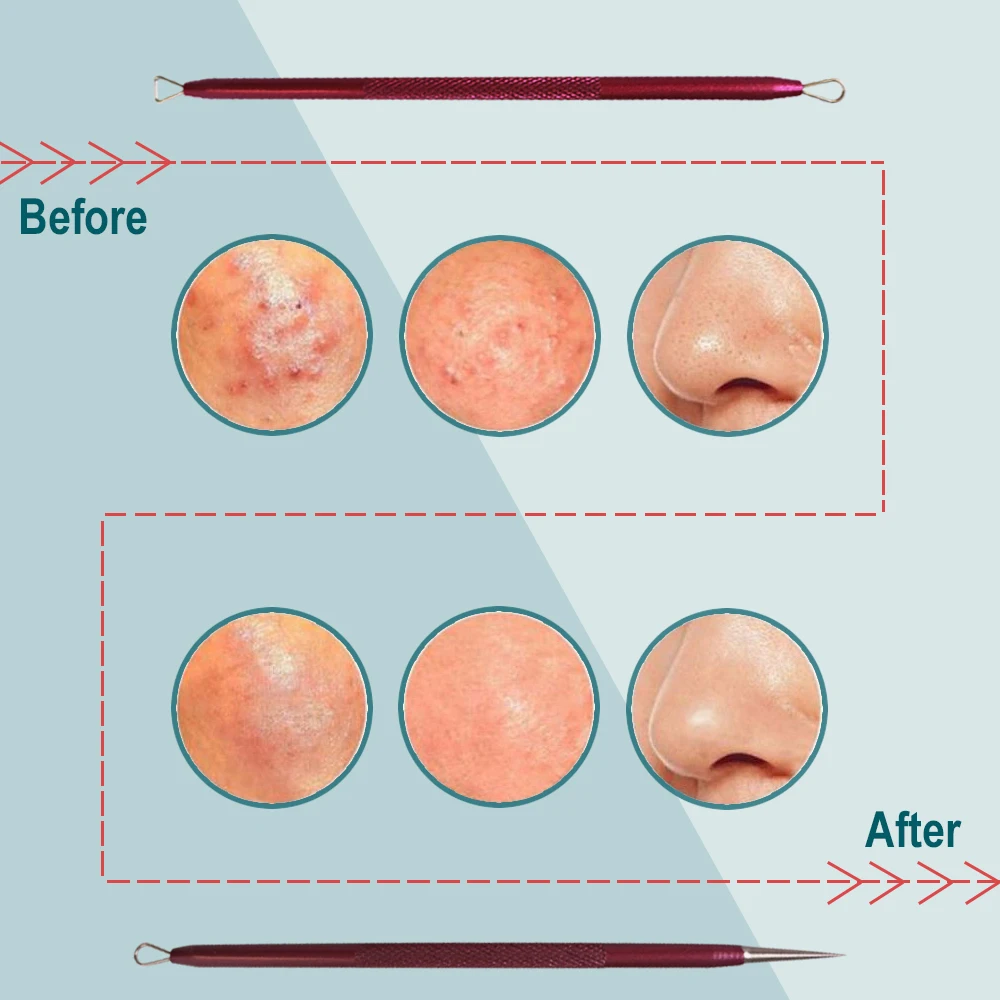 Инструмент для ухода за кожей из нержавеющей стали, средство для чистки лица, экстрактор черных точек, средство для удаления комедонов