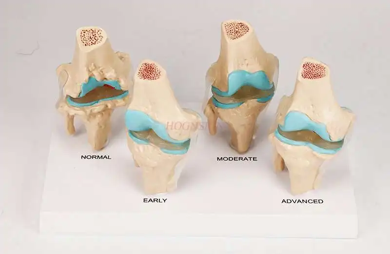 

Human knee degeneration / lesion demonstration model Skeletal model Functional human joint model