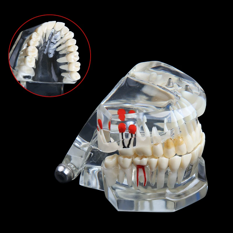 Dental Implant Disease Teeth Model With Restoration Bridge Tooth Dentist For Medical Science Dental Disease Teaching Study