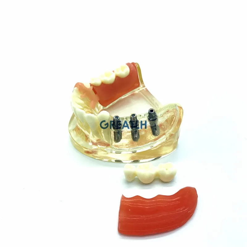 Dental Implant Restoration Teeth Model Removable Bridge Demonstration Model Teeth Dental restoration study model