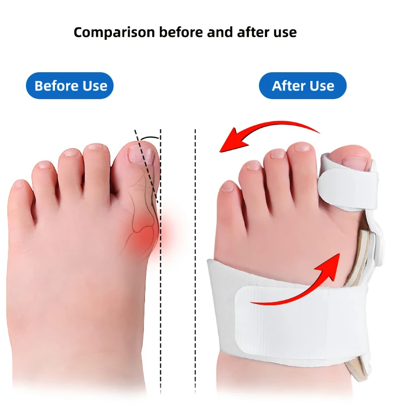 1Pcs Big Toe Straightener Splint Hallux Valgus Corrector Foot Care Tools Pain Relief Supplies For Children Bunion Orthopedic