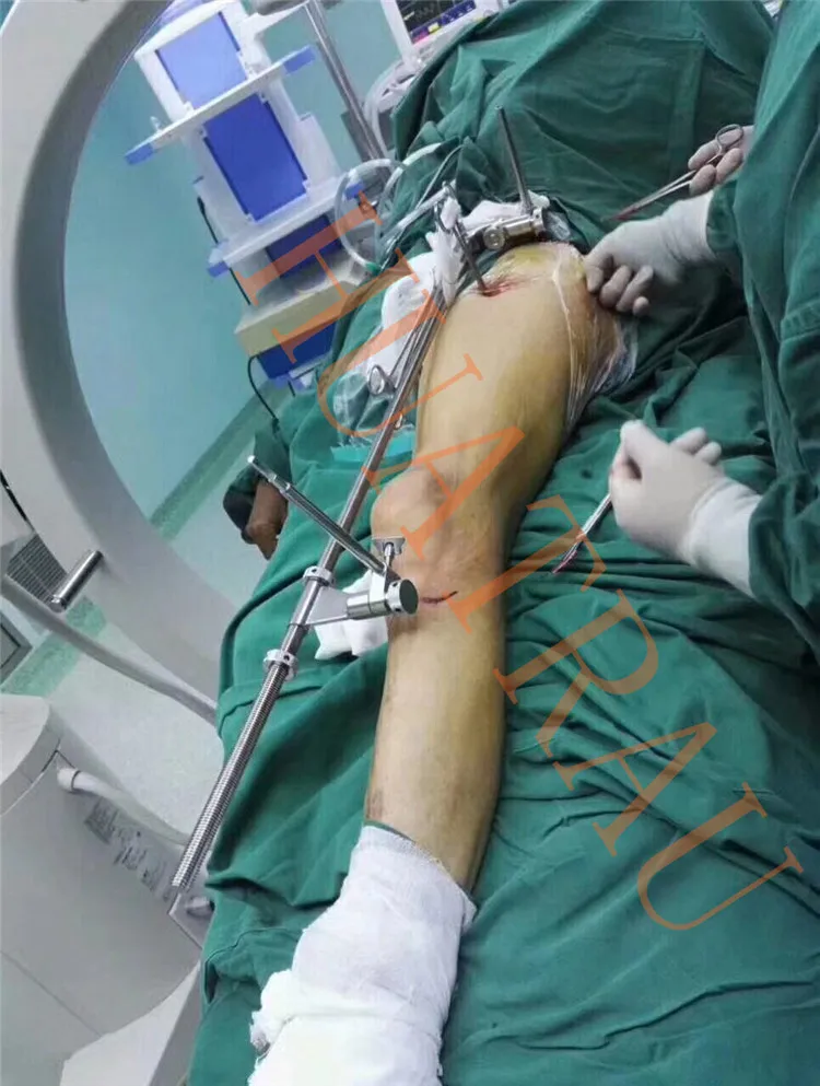 정형외과 기구 의료 골절 감소 기구 키트 하지 대퇴골 경골 역방향 견인기 견인기 겸자