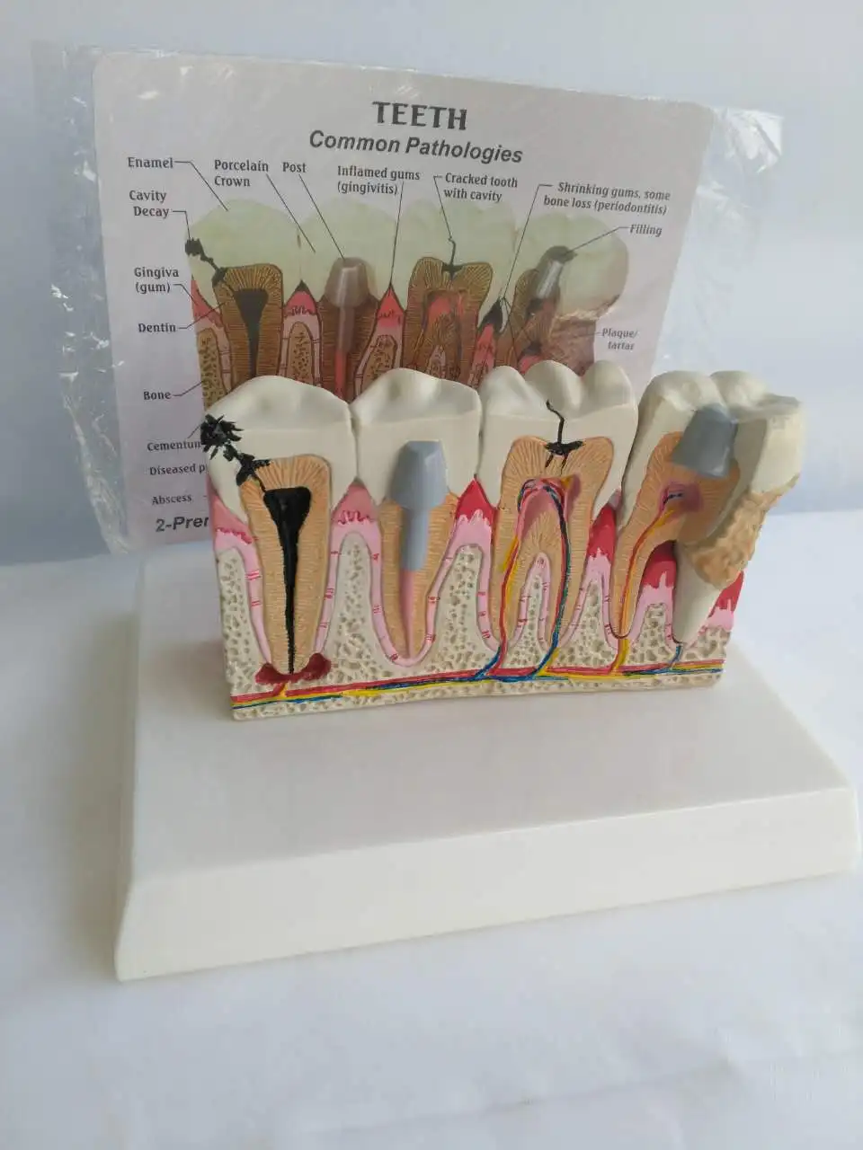 Human Tooth Common Pathologies Anatomy Model   Dental Model Medicine Teaching Instrument