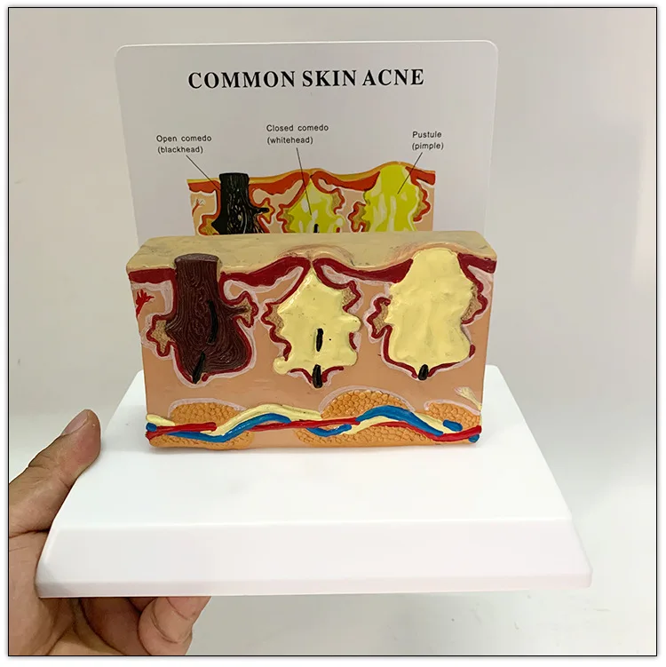 Common Skin Acne Enlarge Structure Anatomical Model Tissue Hierarchical Micro Plastic Surgery Suture Beauty Teaching