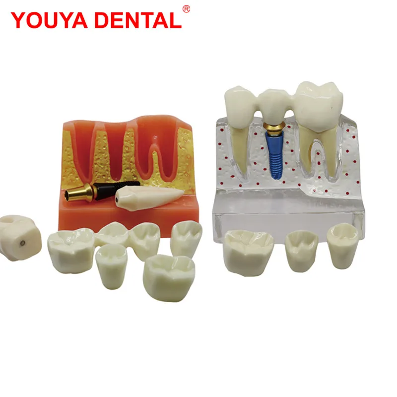 New 4 Times Implant Dental Model Teeth Teaching Model For Studying  Dentist Patient Education Demonstration Dentistry Products