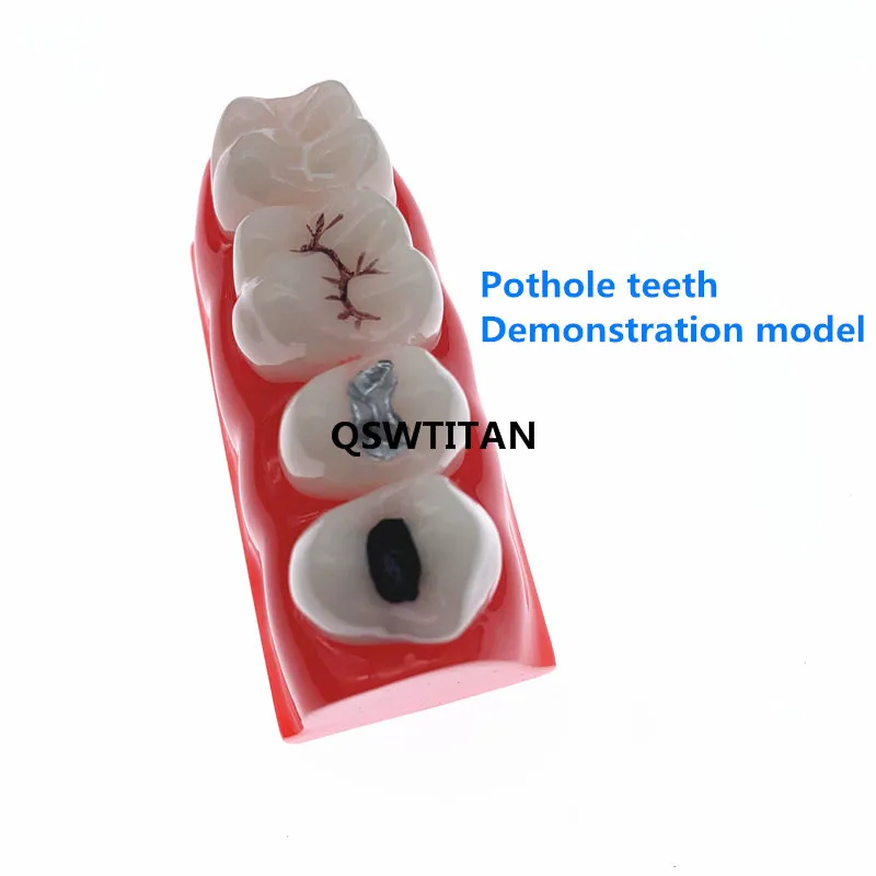 Badanie stomatologiczne dowiedzieć się Model dla Pit i szczeliny uszczelniania, model zębów