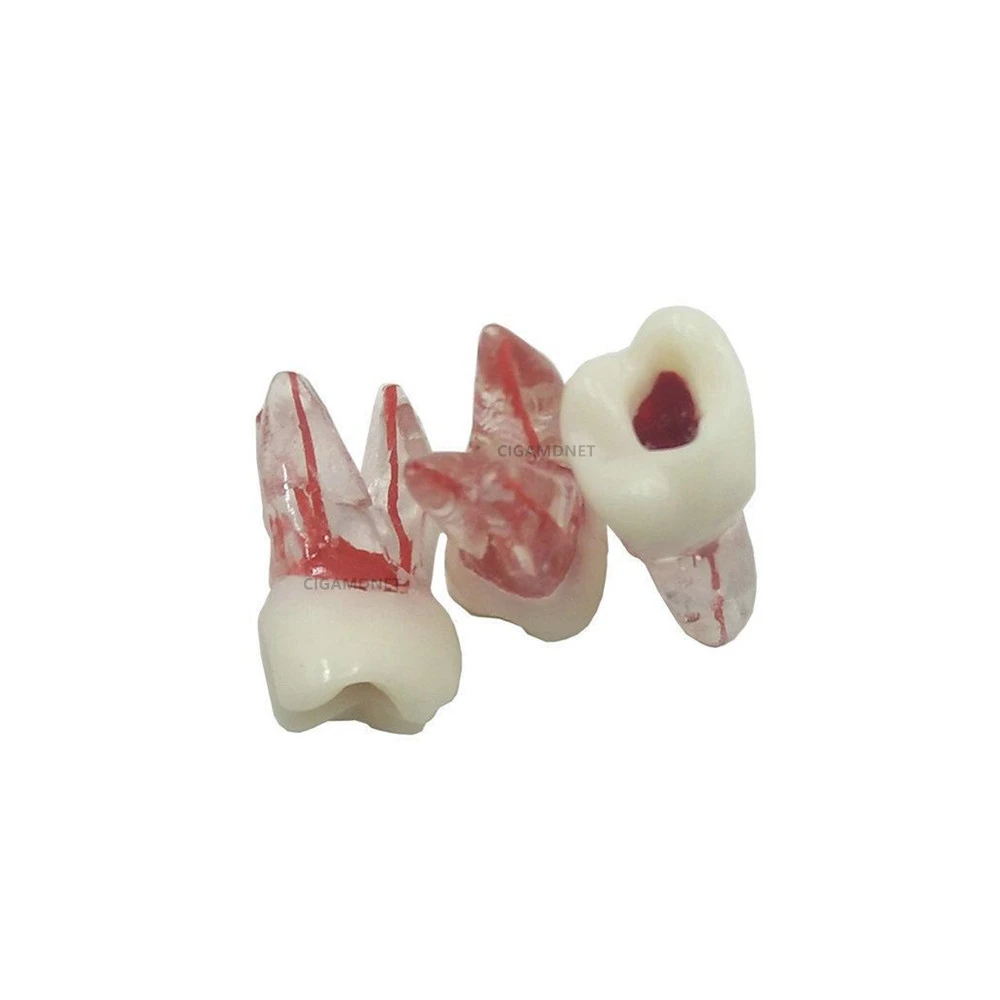 Dental Typodont Tooth Endo Root Canal Study Model For RCT Practice Block Pulp Cavity Endodontic Files