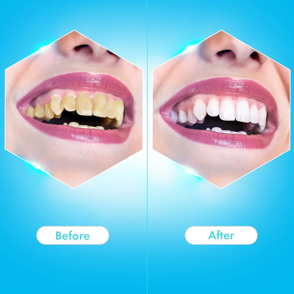 الكهربائية سونيك مبيضة أسنان الأسنان حساب التفاضل والتكامل مزيل بقع الأسنان الجير أداة طبيب الأسنان تبييض الأسنان فرشاة الأسنان الكهربائية