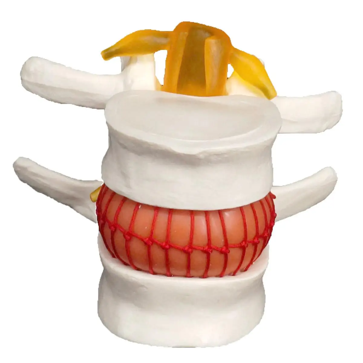 Model Lumbar manusia cakram anatomi medis herniasi bantuan pembelajaran Instrume latihan mengajar pendidikan alat bantu