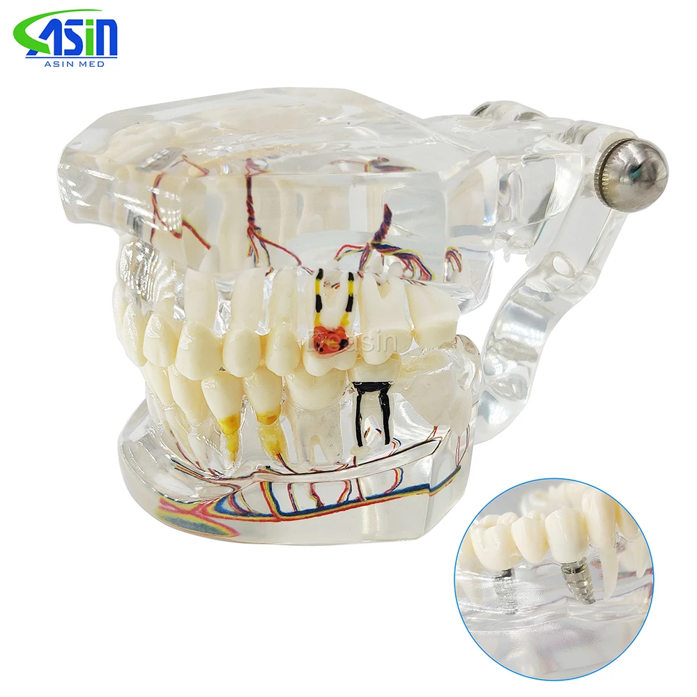 High quality dental teeth model Transparent pathological implant nerve model Repair model Teaching demonstration model