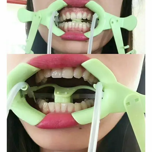 Imagen 2 del producto Retractor Dental Nola, sistema de campo seco Oral con Sub Saliva, Retractor de labio y mejillas, abridor de lengua y boca, expande de mejillas