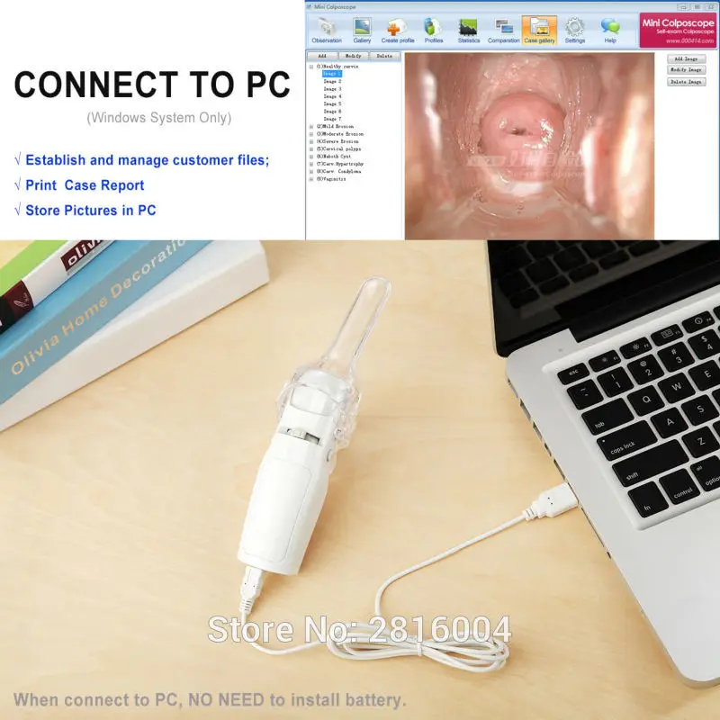 Mini Colposcope Vaginal Endoscope Colposcopy Portable Digital Video Electronic Self-exam Speculum Mirror for Hospital Clinic USB