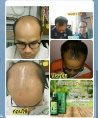 120ml Ne Hair Lotion Hair Root HAIR BEARD SIDEBURNS LONGER Herbs Treatment 100% Original Thailand Free Gift