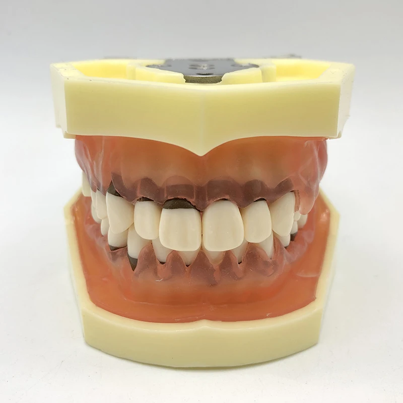 Dental Model Periodontics Calculus Demonstration Teaching Dentists Communication Model 1pc