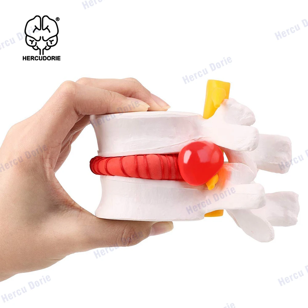 

Модель диска с грыжами человека, модель диска с анатомическими грыжами поясничных позвонков для медицинского обучения, обучения детей