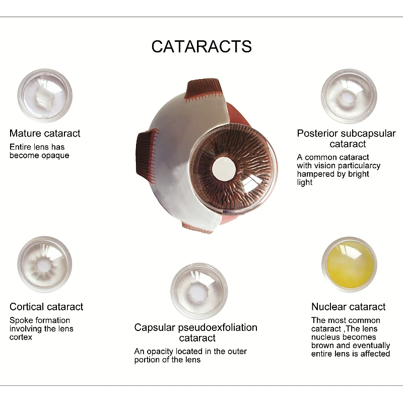 Modelo de enseñanza médica de Anatomía de catarata, ojo humano de Pvc, 4 Uds.