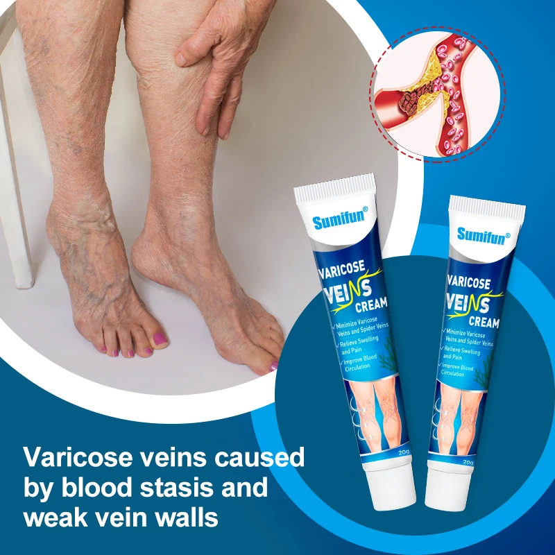 Sumifun Varicose Vein Cream Varicosity Angiitis Spider Removal Legs Dilated Treatments Patch Phlebitis Pain Relief Health Care