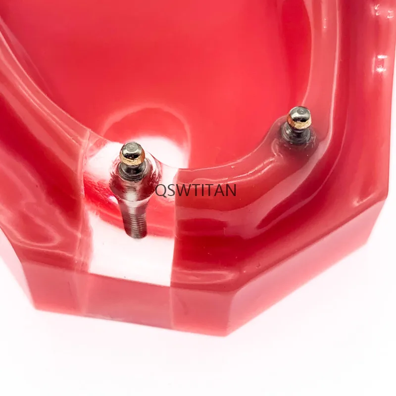 Dental Implant RestorationTeeth Model Overdenture Removable Bridge Denture Demo