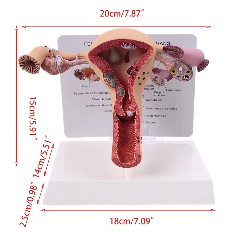 Biology Teaching, Anatomy Lesion Uterus Model, Human Female Uterus Ovary Disease Dissection Pathology Model