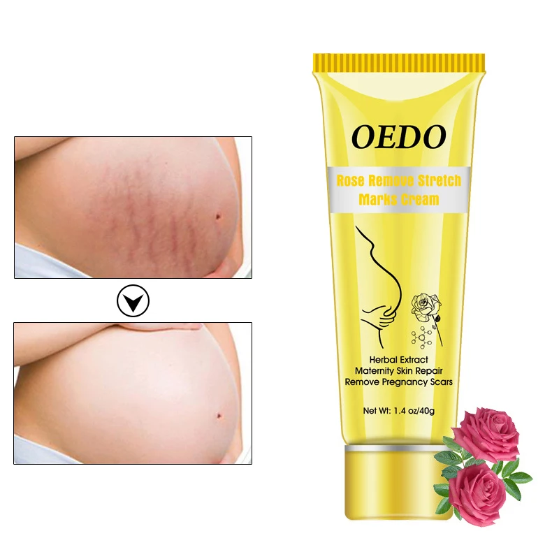 أفضل كريم لعلاج علامات التمدد أثناء الحمل: تجربة حقيقية مع OEDO Rose للعناية بالبشرة بعد الولادة