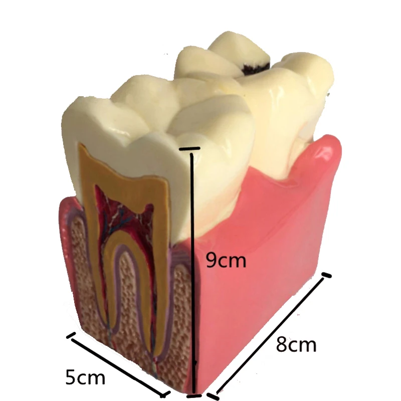 1pc dental teeth model dentist study 6 Times Caries Tooth models Dentist teaching Studying Researching dentistry dental products