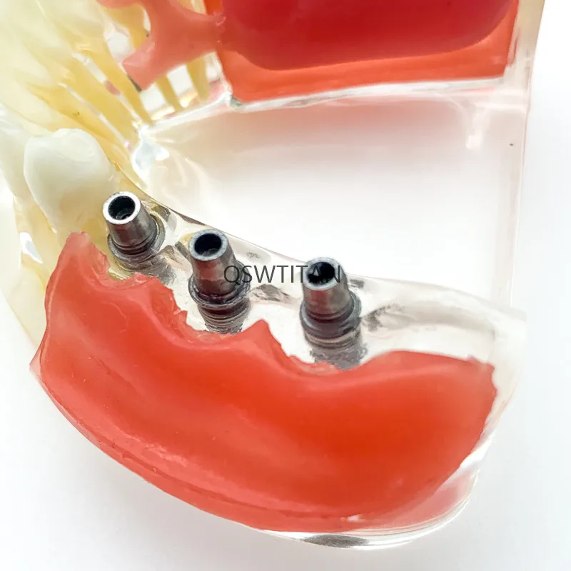 Dental Implant RestorationTeeth Model Overdenture Removable Bridge Denture Demo