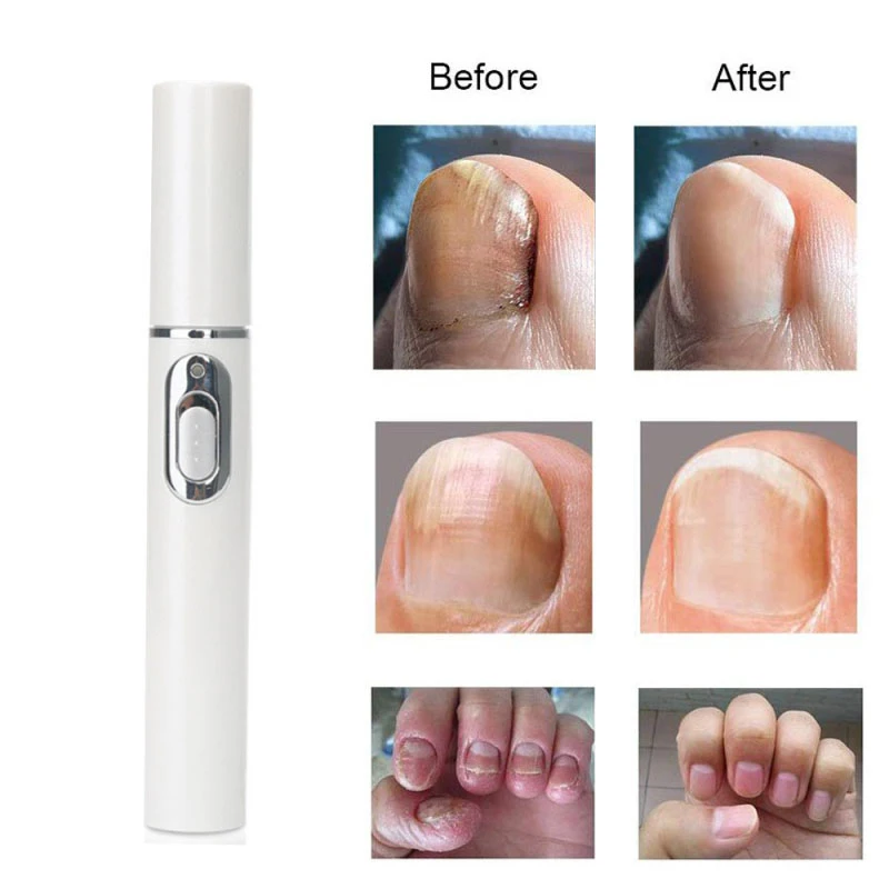 Hot Nail Fungal Pen Anti Fungus Blue Light Laser Pen Onychomycosis Painless Nail Repair Pen Nail Care Repair Serum Free Shipping