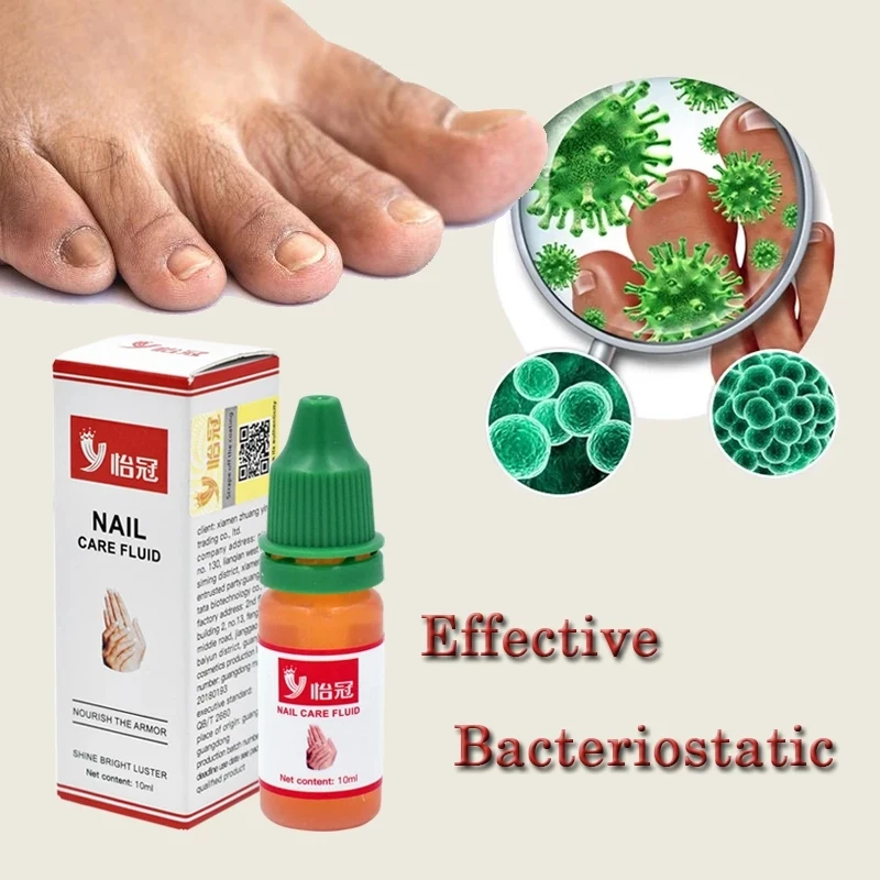 

10ML Yiguan Nail Liquid Treatment Toenail Fungus Removal Gel Foot Care Essence Nail Foot Whitening Bright Anti-infection