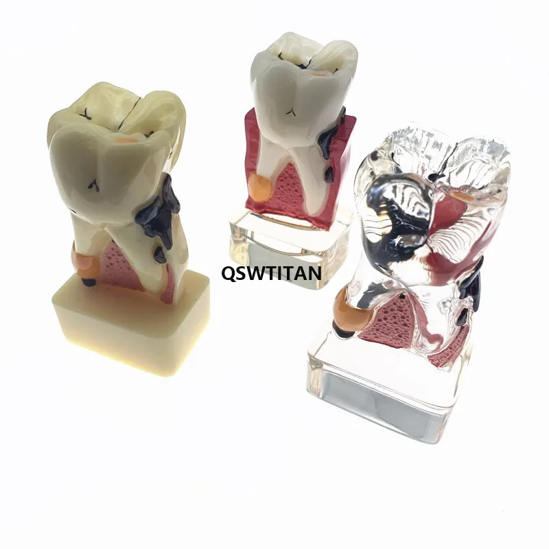 Dental Teeth Model 4 times tooth pathology model Comprehensive Periodontal Model For Teaching Study model