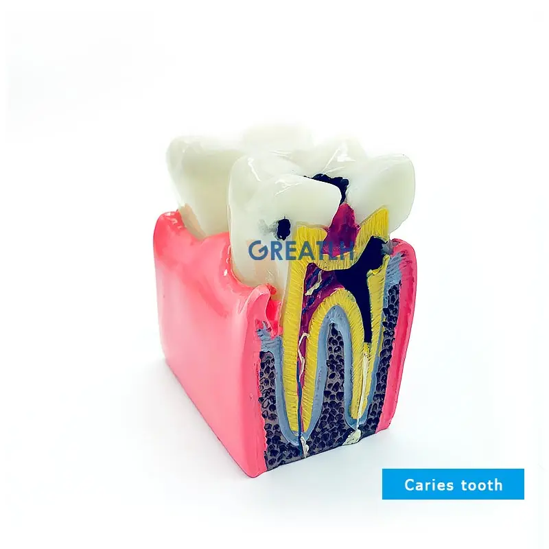 Teeth Model Teeth Disease Teaching Model Caries Model Dental Model Dentistry Products