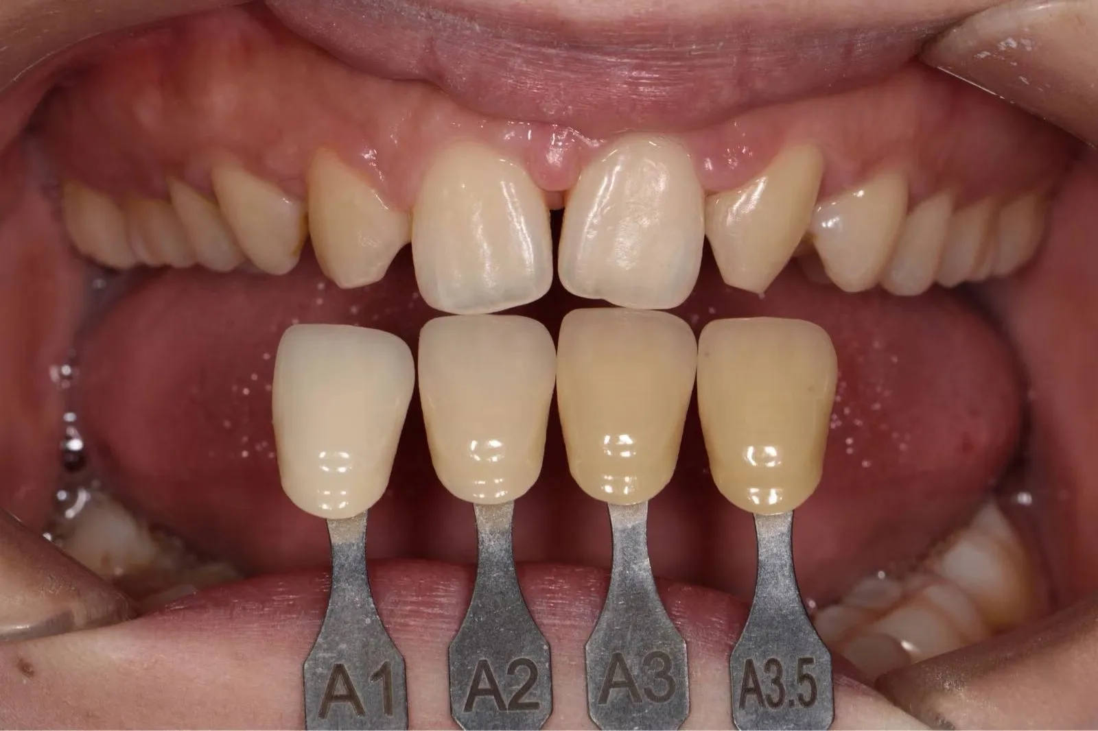 10 Uds LT lingote de cerámica de vidrio Dental cubos de disilicato de litio y lingote de prensa basado en pastillas para incrustaciones de chapa de dentadura