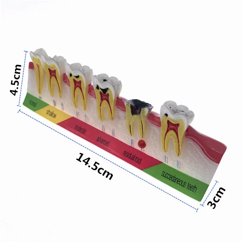 Dental Tooth Model of Pathological Process Around Teeth Caries Evolution Decayed Model Caries Classify