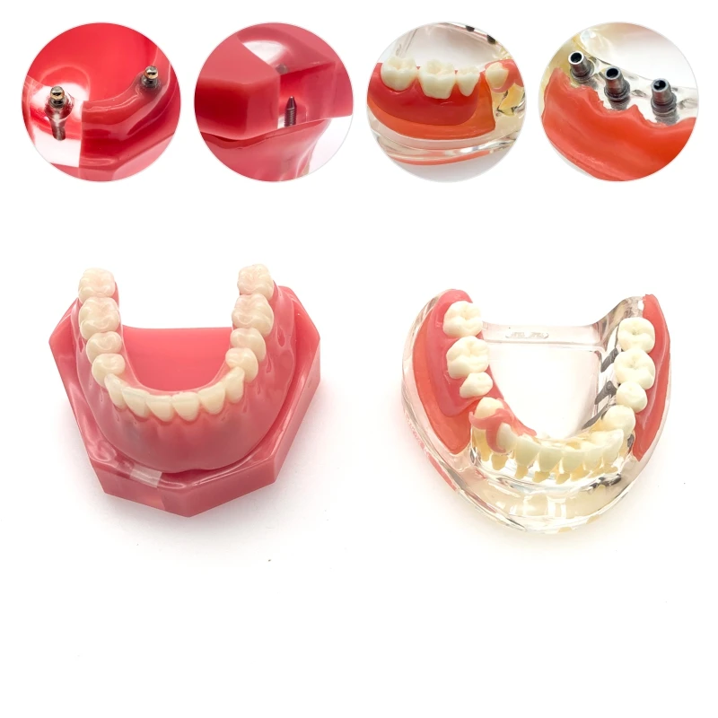 

Dental Implant RestorationTeeth Model Overdenture Removable Bridge Denture Demo