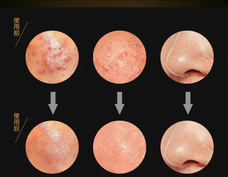 Pinzetta per punti neri per acne Pinzetta per rimozione comedoni brufolo in acciaio inossidabile Estrattore Pinzetta per la cura della pelle del viso Pulizia Strumento di bellezza Vendita
