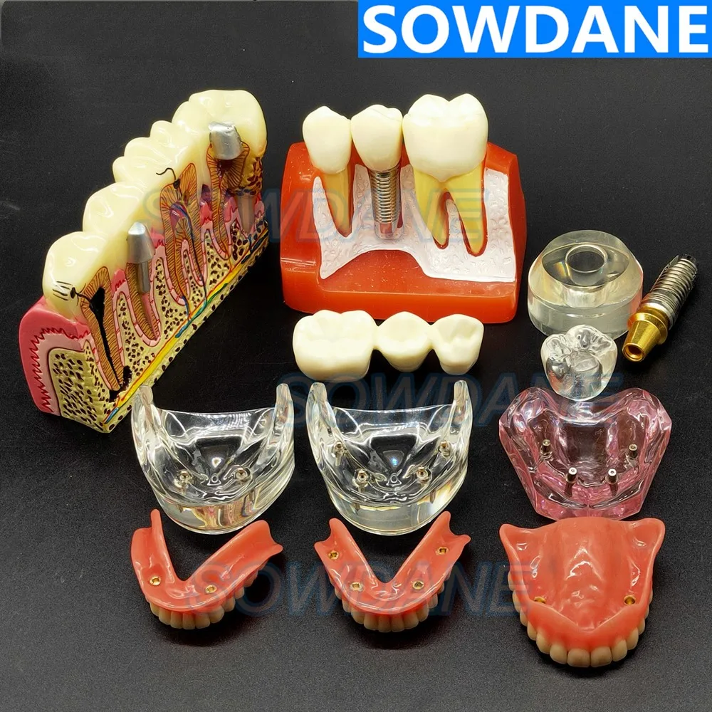 Dental Implant Demonstration Model Teeth Study Teach Model Disease Analysis with Restoration Crown Bridge Maxillary Mandibular