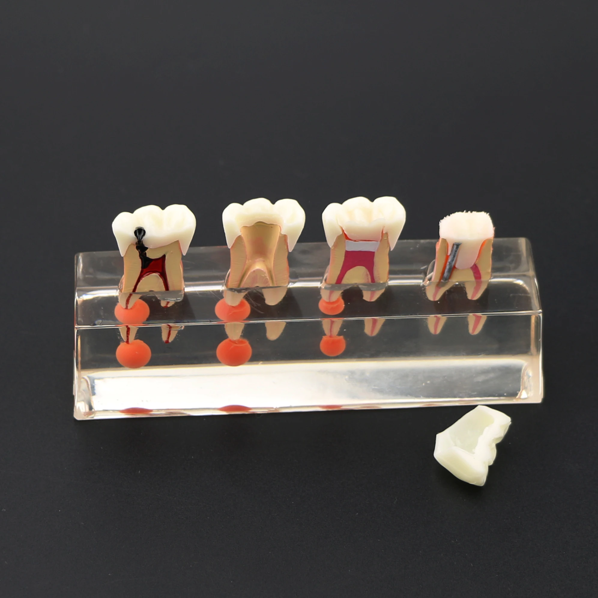 Dental Teeth Model 4-Stage Endodontic Treatment Clear Demonstrates Model for Study Teaching Clinic Decoration