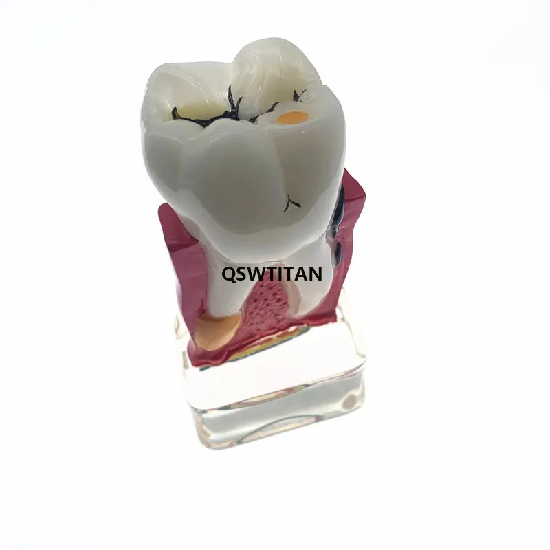 Dental Teeth Model 4 times tooth pathology model Comprehensive Periodontal Model For Teaching Study model
