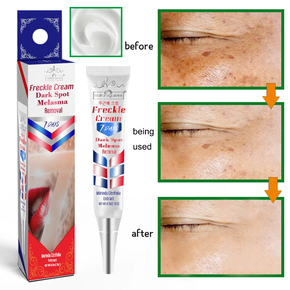 Instant Whitening Freckle Cream Face Treatment Remove Dark Spots Melasma Pigment Melanin Acne Spot Skin Care Korean Cosmetics