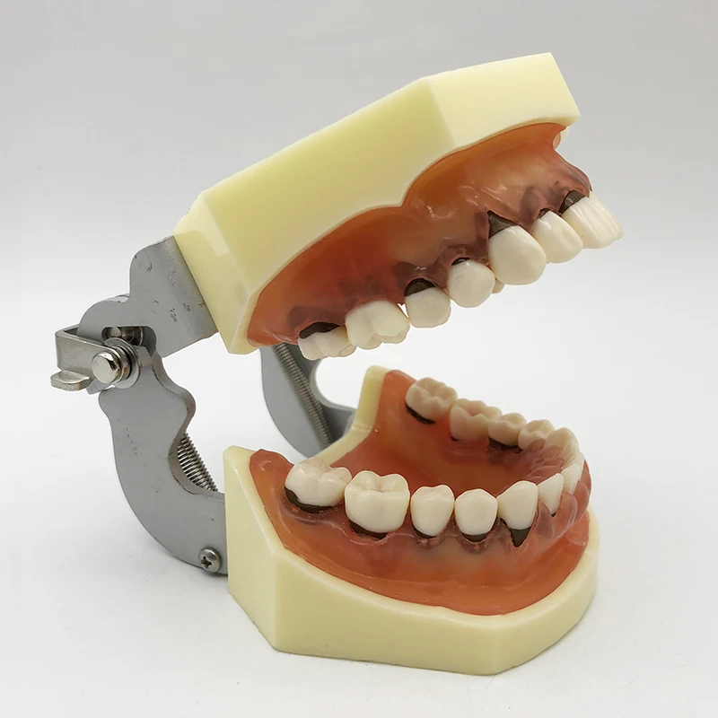 Dental Model Periodontics Calculus Demonstration Teaching Dentists Communication Model 1pc