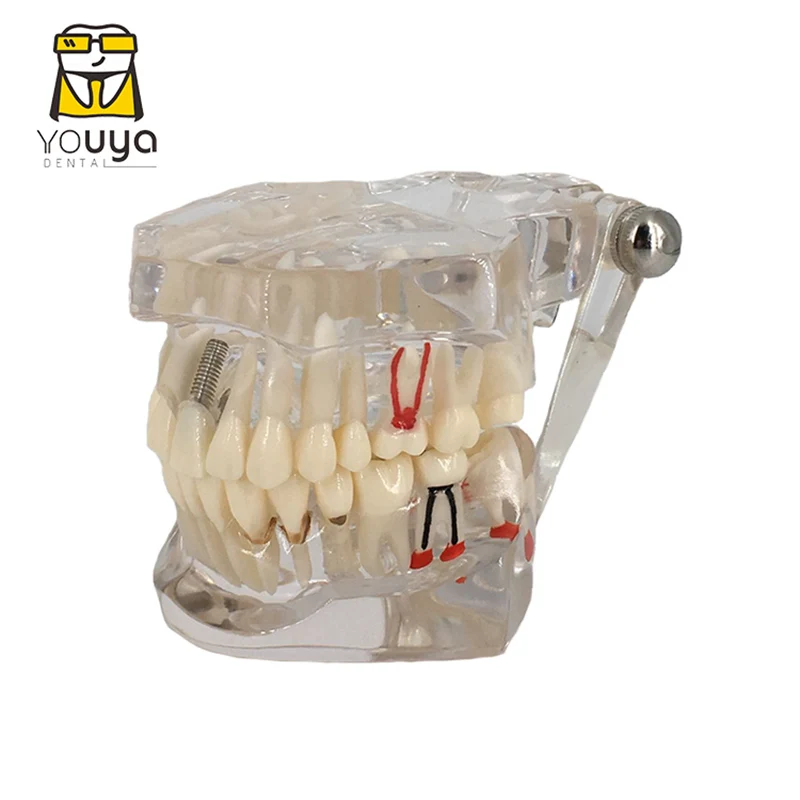 Transparent Disease Teeth Model Dental Implant Teeth Model Dentist Dental Student Learning, Teaching, Research Communication