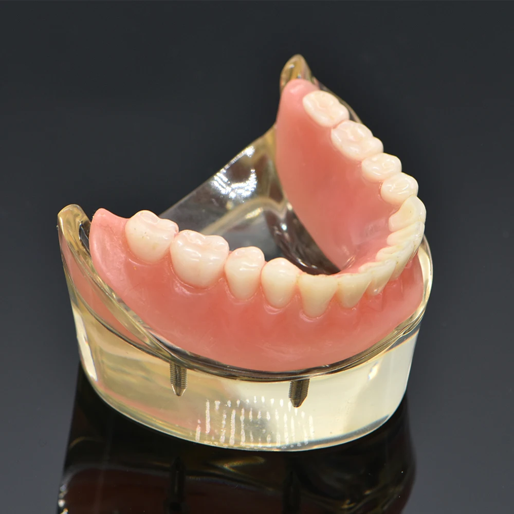 Dental Overdenture Teeth Model Removable Interior Mandibular Lower Teeth Model Mandibular with Implant for Tooth Teaching Study