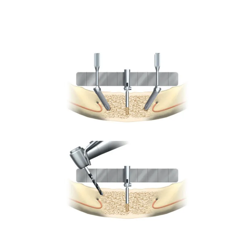1SET Dental Implant Locating Guide Surgical Planting Positioning Locator Dental Positioning Angle Ruler Guage Autoclavable