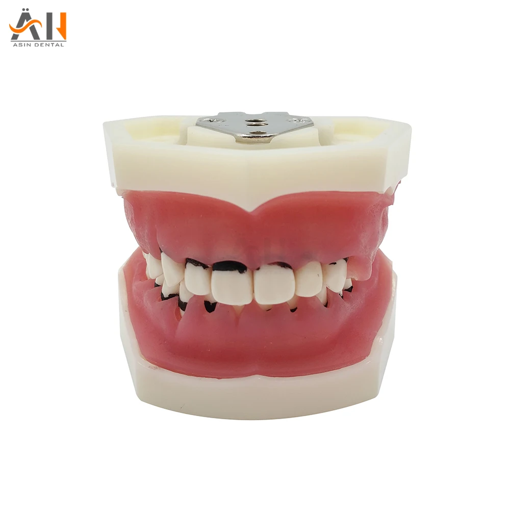 High Quality Dental Periodontal Disease Model / Tooth Medical Model