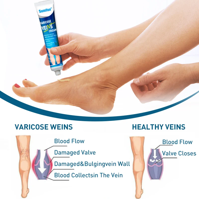 Sumifun 1pcs Vasculitis Phlebitis Spider Cream Varicose Veins Treatment Cream Varicosity Angiitis Removal Medical Plaster P1234