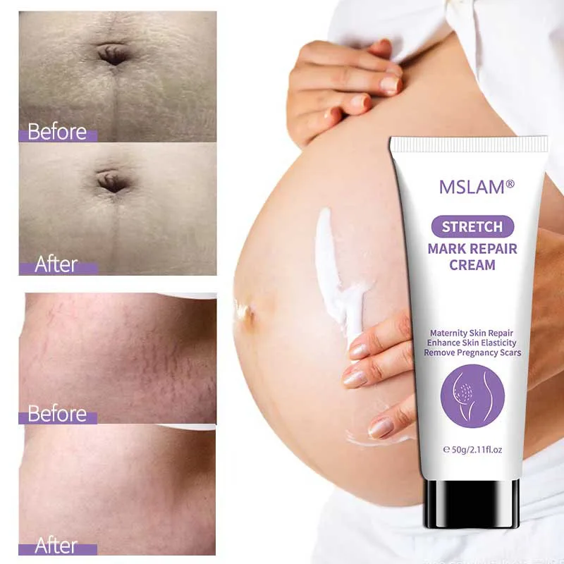 MSLAM Maternity Stretch Mark Prevention Cream - Paraben-Free, Hypoallergenic, Safe for Pregnancy-Dermatologists Recommend 50g