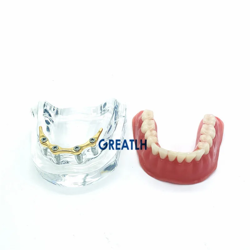 Modelo de implante mandibular para dentes, modelo para reparação de dentaduras e próteses dentárias