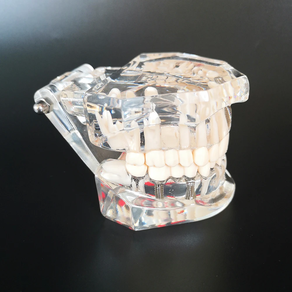 Neues Dentalmodell für Zahnimplantate, Restaurationsbrücken, Lehrmaterial für Medizinische Wissenschaft, Krankheiten, Zahnärzte und Zahnmedizinprodukte – Detail 3