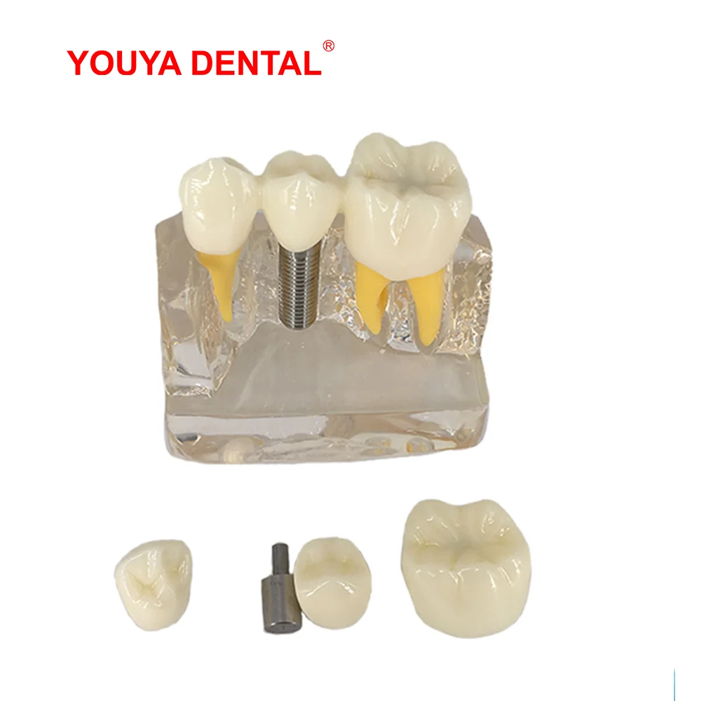 Dental Model Resin Transparent 4times Tooth Implant Model For Dentist Student Demonstration Teaching Module Oral Medical Product